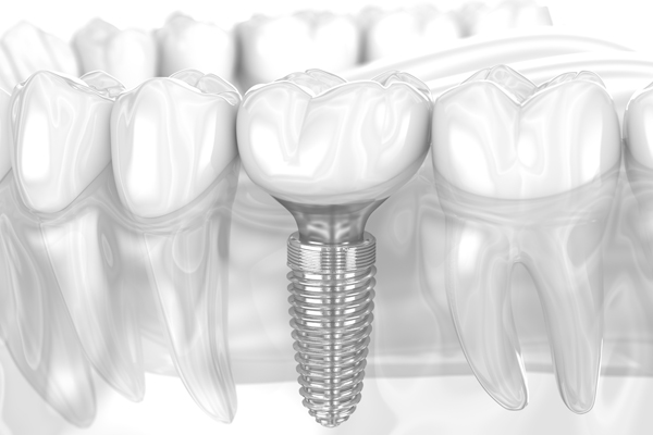 Is It Painful To Get A Tooth Implant?