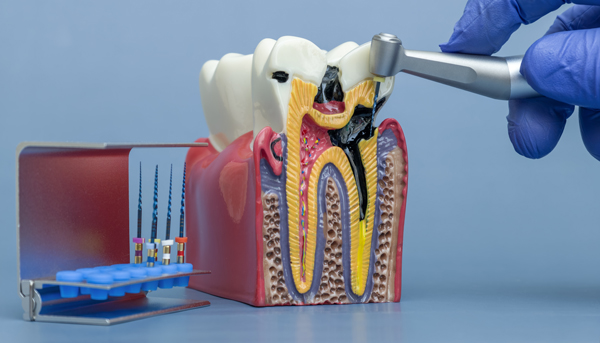 What Happens After A Root Canal?